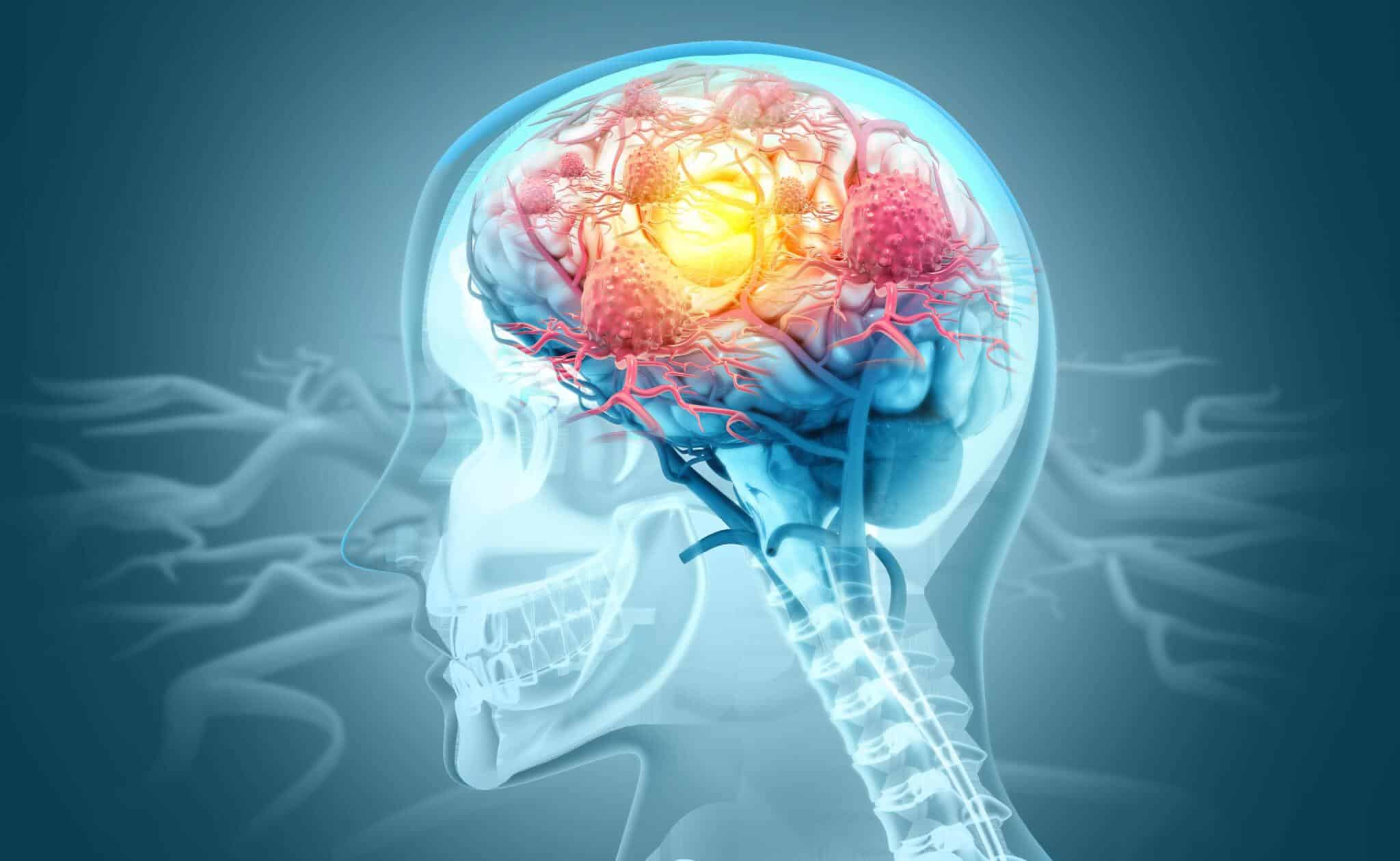 Is Stem Cell Therapy A Cure For Neurodegenerative Diseases