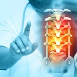 Stem Cell Therapy: A Non-surgical Alternative To Spinal Stenosis