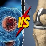 Stem Cell Therapy Vs. Knee Replacement: Which One To Choose?