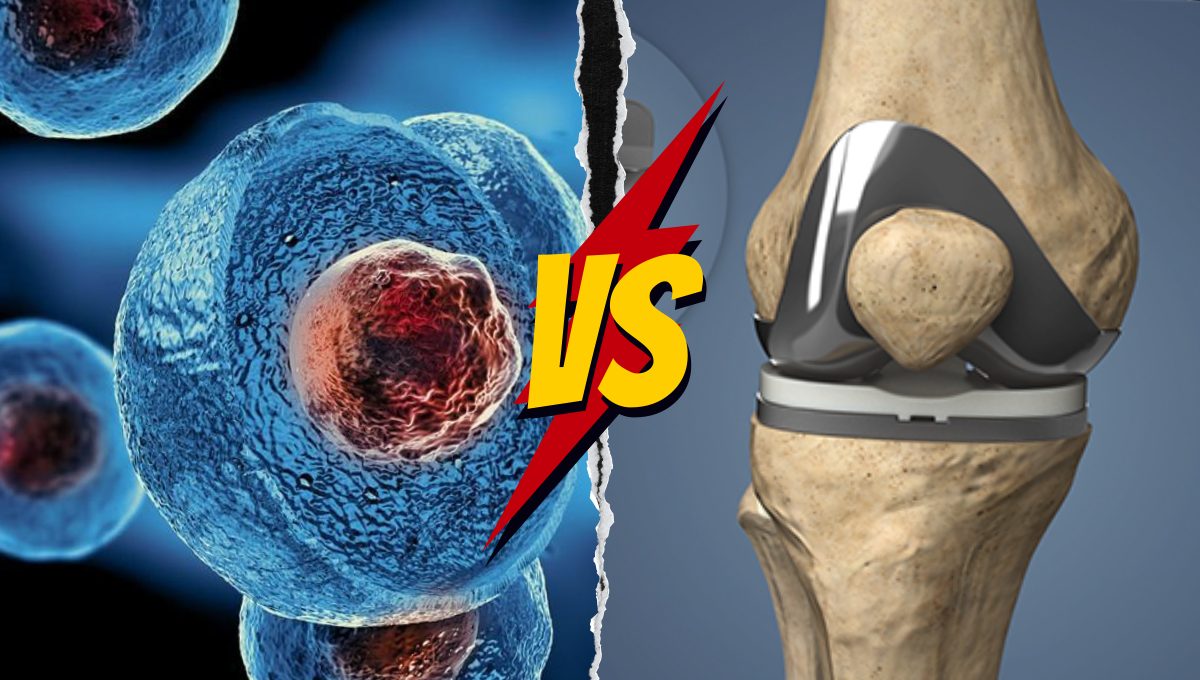 Stem Cell Therapy Vs. Knee Replacement: Which One to Choose?