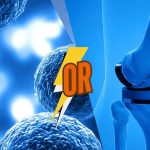 Stem Cell Treatment or Knee Replacement Surgery