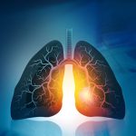 How To Suppress Inflammation for COPD and RA Patients with Stem Cell Therapy?
