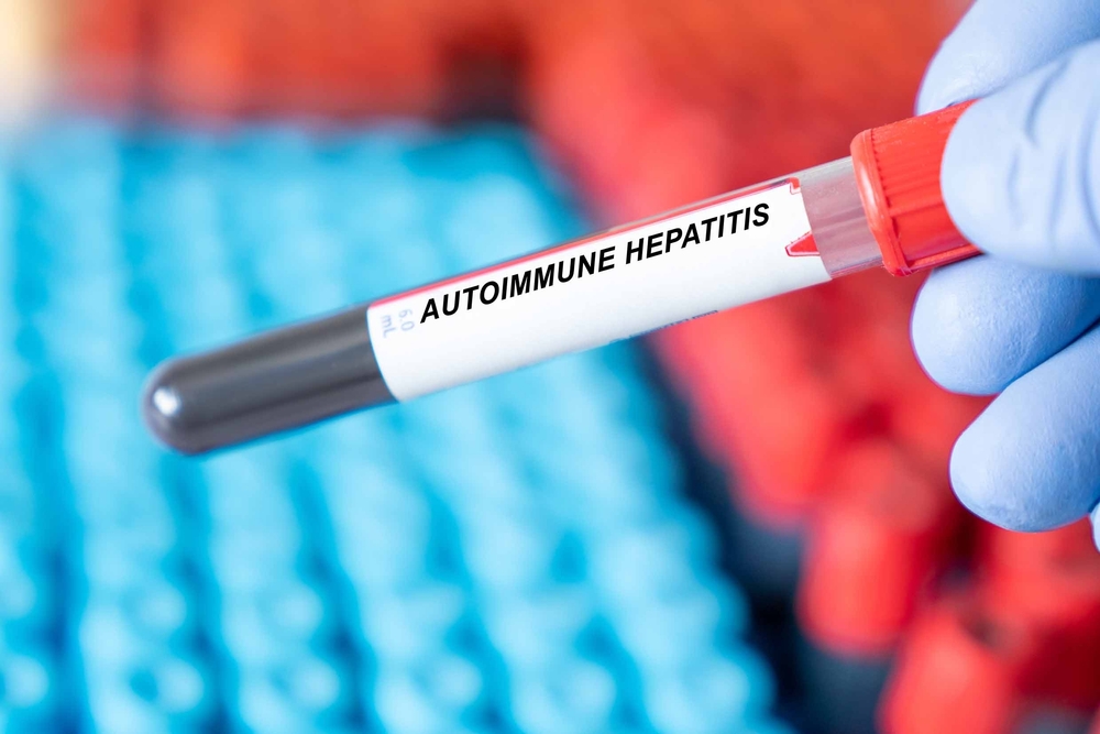 Stem Cell Therapy for Autoimmune Hepatitis: A Revolutionary Cure