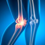 How To Manage Post-Meniscectomy Knee Pain with Stem Cell Therapy