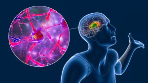 How To Recover from Neurodegenerative Diseases with Stem Cell Treatment