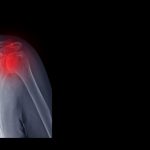 Remarkable Results of Stem Cell Therapy for Glenohumeral Osteoarthritis Treatment