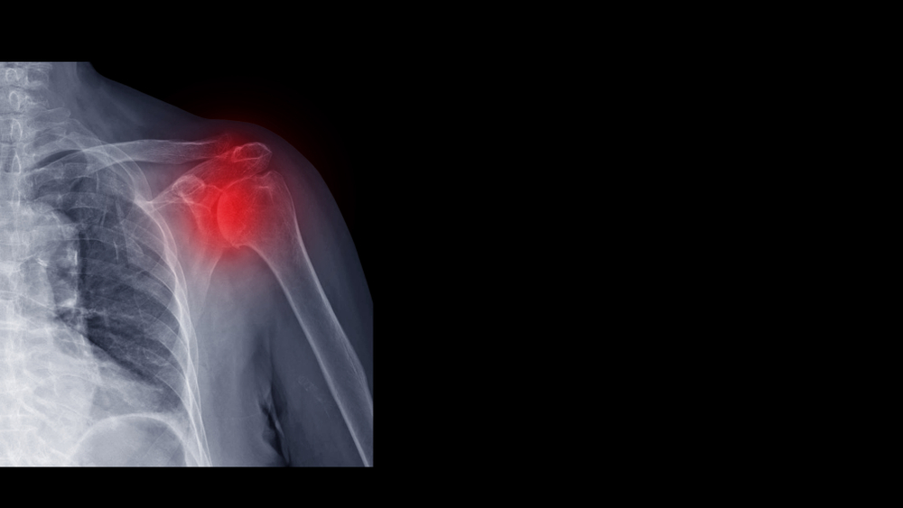 Remarkable Results of Stem Cell Therapy for Glenohumeral Osteoarthritis Treatment