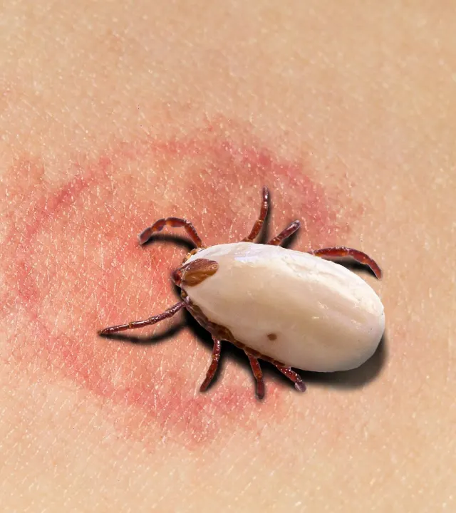 Lyme Disease