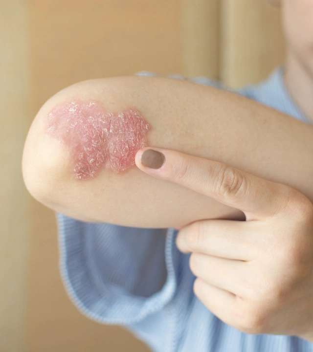 Psoriasis