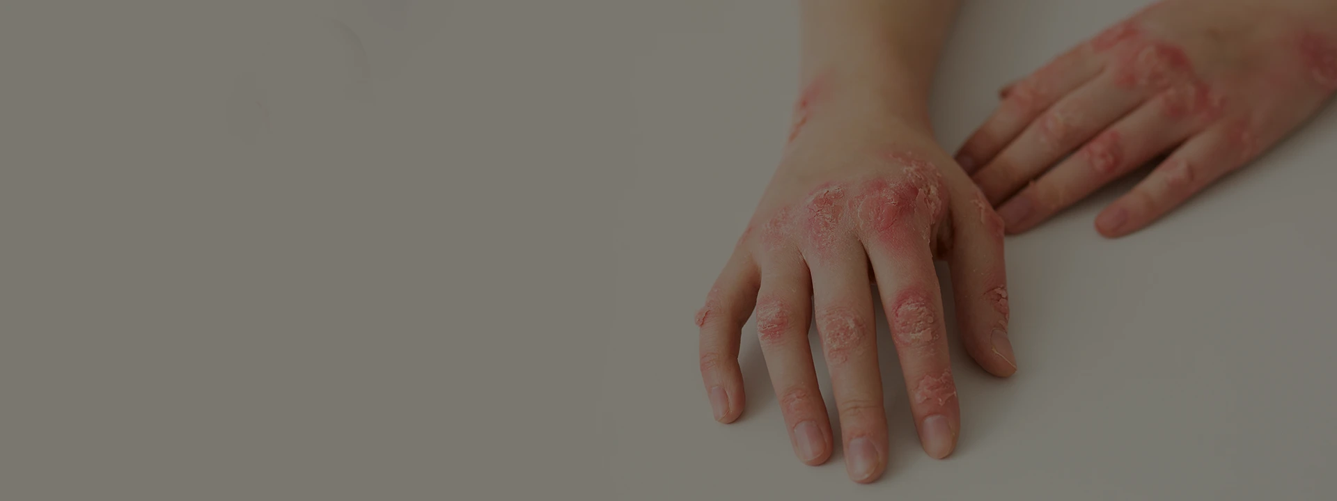 Psoriasis